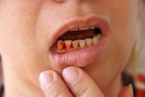 Bleeding or pain is reason for emergency visit to Mint Family Dental