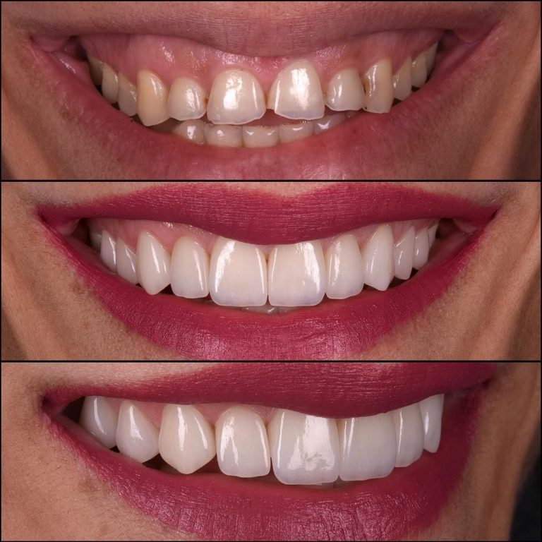Mint Family Dental Porcelain Veneers